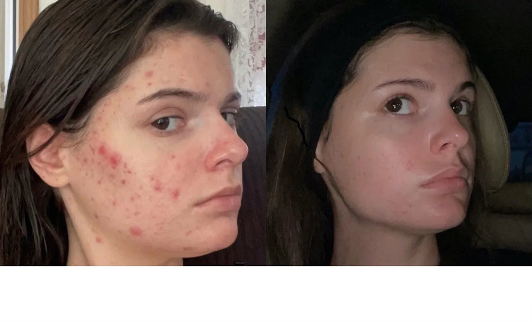 Before and after comparison of a woman's skin showing reduction in acne and redness.