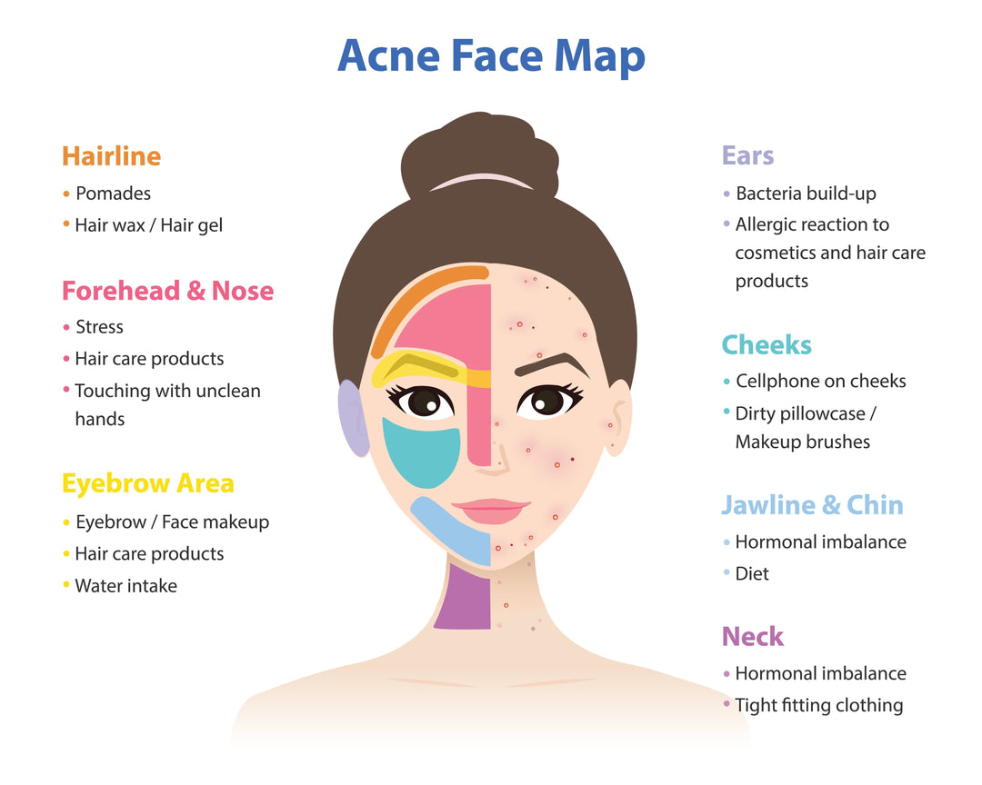 Animated acne face map- shows a woman with different section of her face highlighted in different colors then the corresponding explanations on either side of her face