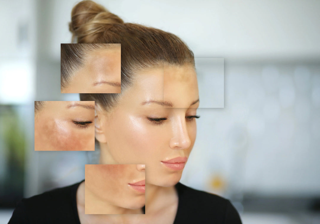 Close-up of a woman's face showing clear skin with magnified patches of skin discoloration and hyperpigmentation