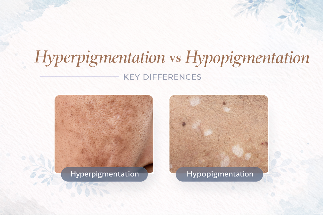 Comparison image showing hyperpigmentation (dark spots) vs hypopigmentation (light patches) on skin.