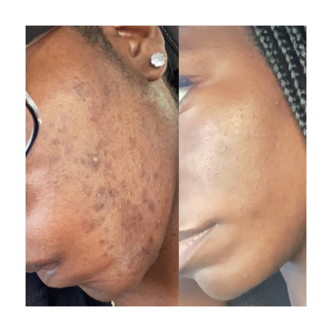 dark skin acne before and after