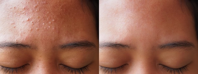 Side by side of a young woman's forehead. The first shows an outbreak of whitehead acne the second is an after picture of it having cleared up