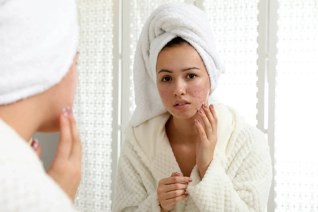 Woman in a white robe and towel examining acne on her face in a mirror.