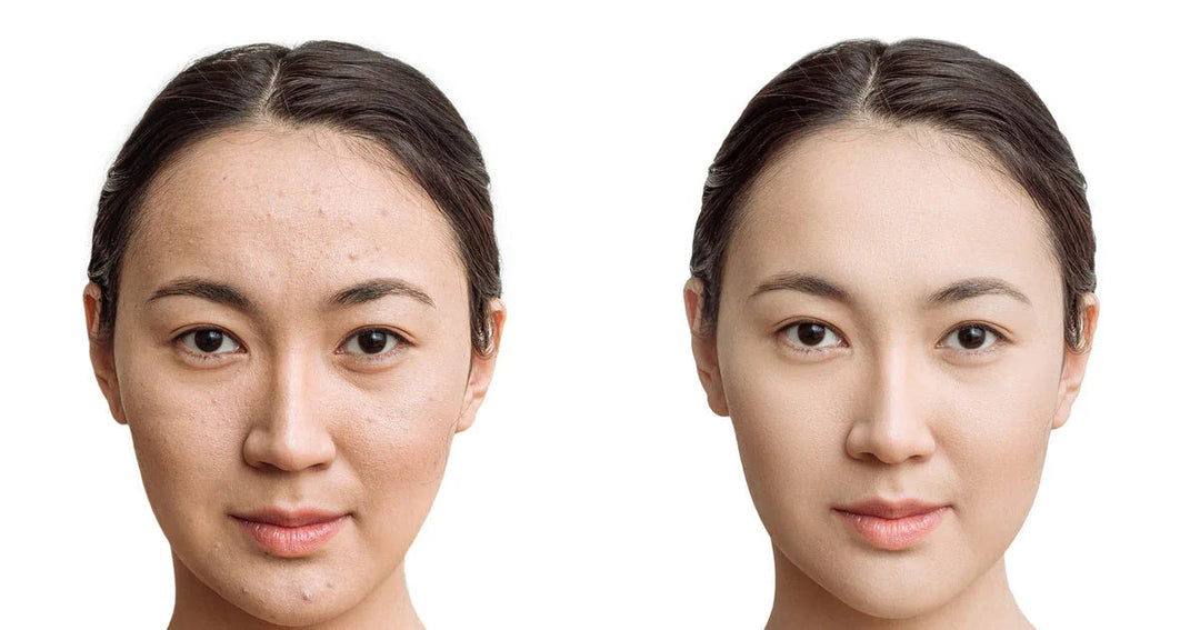 Before and after comparison of a woman's skin showing acne reduction and improved complexion.